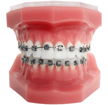 invisalign aligners on plastic model